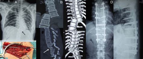 A Rare Case Of Complete T10t11 Fracture And Dislocation With The
