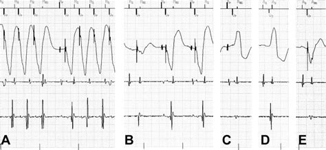 Repetitive Pacemaker Mediated Tachycardia Occurring Only During Left