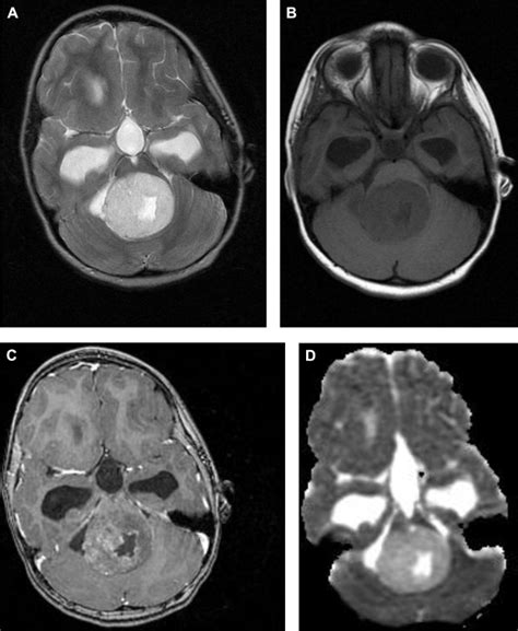 Advanced Mr Imaging In Pediatric Brain Tumors Clinical Applications