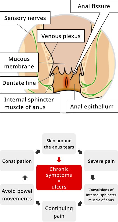 Characteristics Of Anal Fissure｜official Brand Site