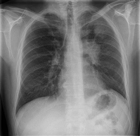 Persistent Hypokalaemia And Abnormal Chest Radiography European