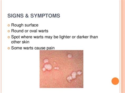 Skin Cancer And Warts
