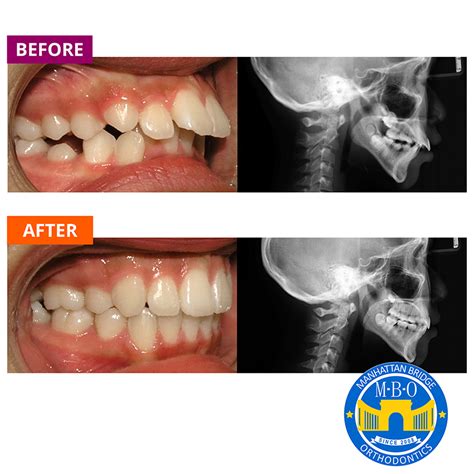 Braces Before And After Overjet