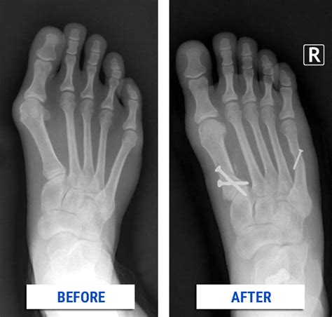 List 90 Background Images Before And After Bunion Surgery Photos Sharp