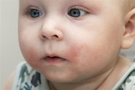 الطفح الجلدي عند الرضع تعرفي على أعراضه وأسبابه وطرق علاجه