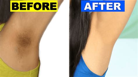 How To Get Rid Of Dark Underarms Overnight Permanently Beauty Ino In
