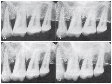 Role Of Radiographic Evolution An Aid To Diagnose Periodontal Disease