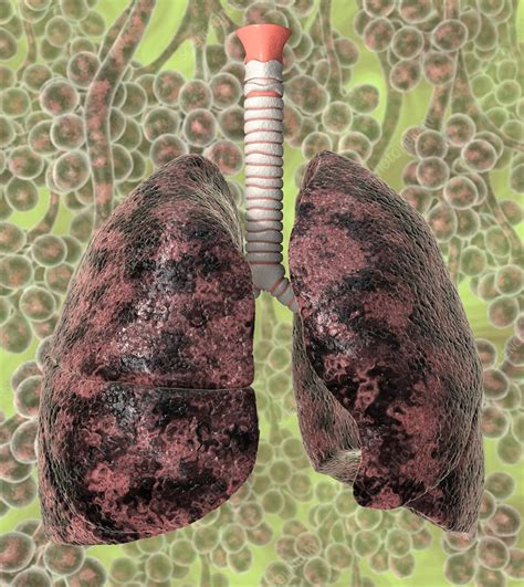 smoker s lungs artwork stock image c012 5449 science photo library