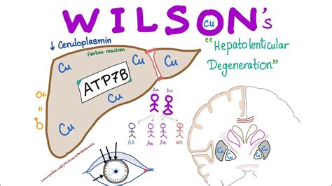 Wilson Disease Causes Symptoms Diagnosis And Treatment
