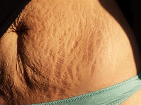 Flaws And All Stretch Marks Go Viral In Support Of Women Entertainment Life Theadvocate Com