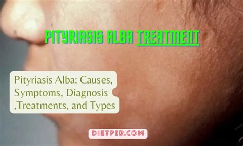 Pityriasis Alba Unveiled Causes Symptoms Diagnosis Treatments