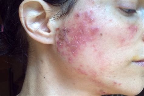 Skin Conditions That Look Like Acne But Arent