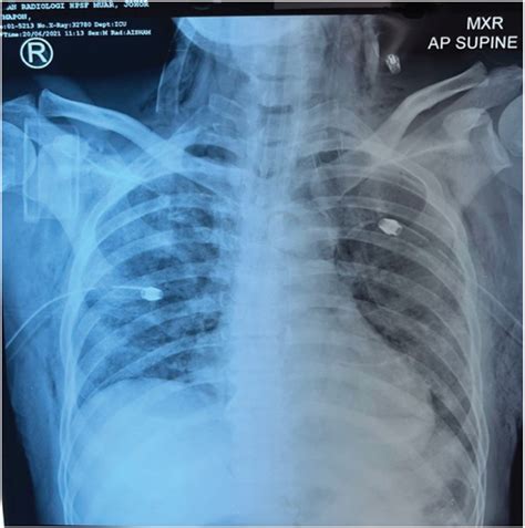 Subcutaneous Emphysema In COVID 19 Managed With Surgical Tracheostomy