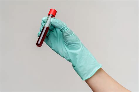 Un nouveau test sanguin rapide et bon marché permet de détecter le cancer avant l apparition des