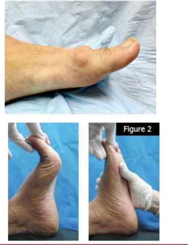 Surgery Hallux Limitushallux Rigidus Flashcards Quizlet