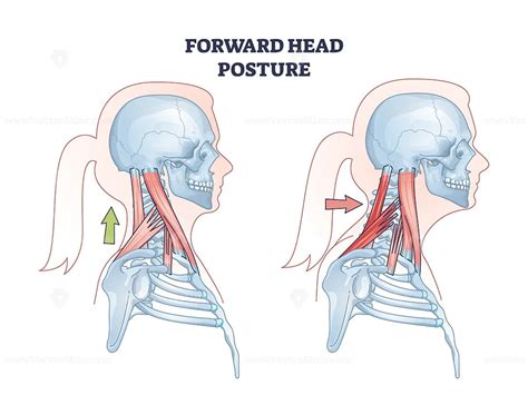 Forward Head Posture Compared With Healthy Neck Position Outline