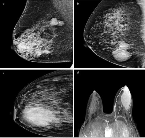 A D Benign Phyllodes Tumor Mammography Imaging A Borderline