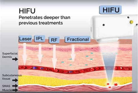Hifu High Intensity Focused Ultrasound Alternative To A Surgical Face Lift
