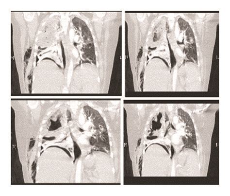 Chest Computed Tomography Revealed Multiple Bilateral Cavitation More