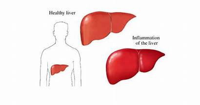 Liver Hepatitis Enzymes Elevated Health Inflammation Healthy