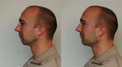 Male Chin Types