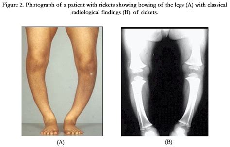 Rickets Causes Signs And Therapy