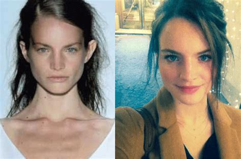 anorexic celebrities before and after