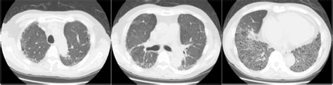 High Resolution Computed Tomography Of The Lungs Download Scientific