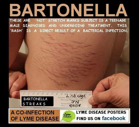 Bartonella Rash Lyme Disease Awareness Skin Disorders Stretch Marks