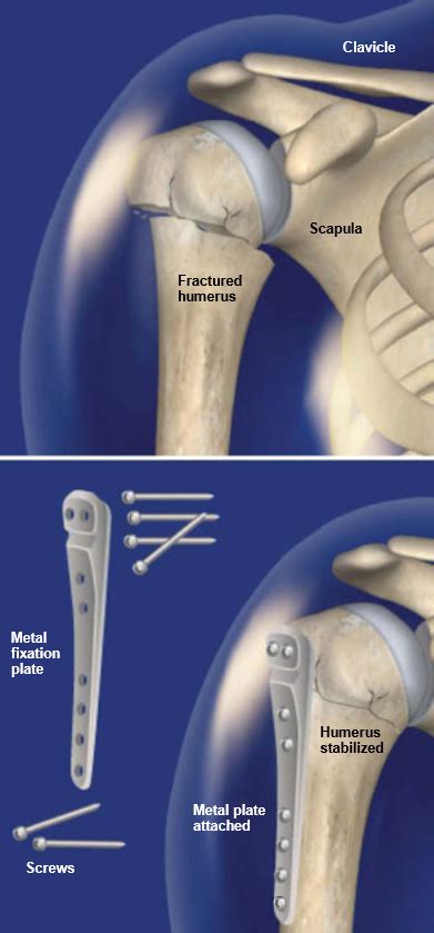 Orif Surgery For Proximal Humerus Fracture Central Coast Orthopedic