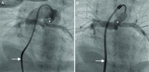 Antegrade Ductal Stenting In A Neonate With Pulmonary Atresia And