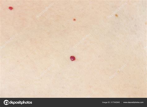Angioma Red Mole Skin Bursting Vessel Capillary Many Angiomas Small