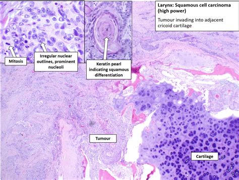 Larynx Carcinoma Nus Pathweb Nus Pathweb