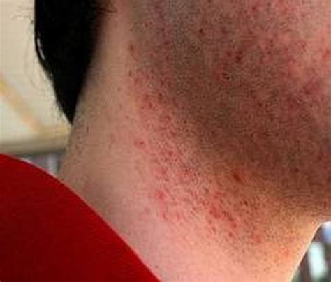 Hiv rash is often (but not always) one of the first symptoms of hiv infection. Pictures of HIV Rash | Medical Pictures and Images - (2020 Updated)