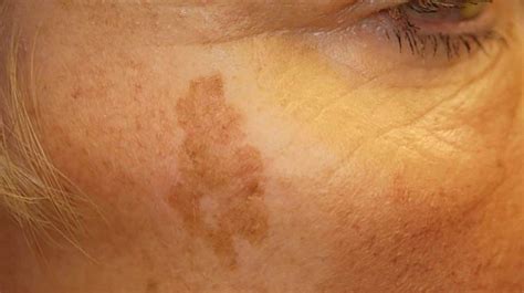 Sunspots On Skin Causes And Treatment Skin Discoloration Sunspots