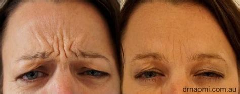 Frown Line Injections Best Clinic Staffed With Experienced Doctors