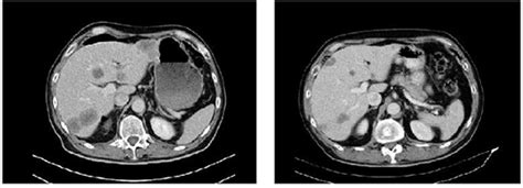 Liver Metastases Ct Scan