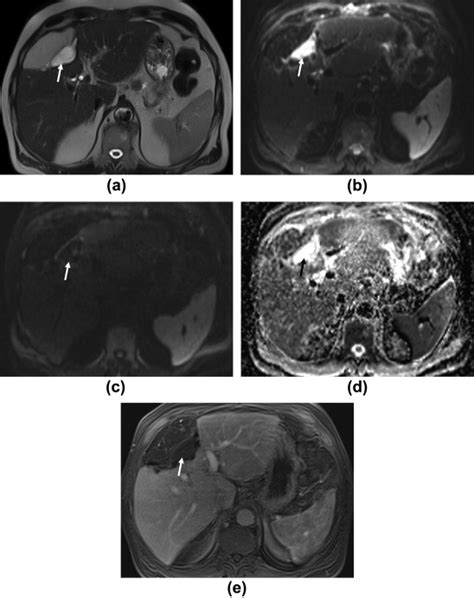 Role Of Diffusion Weighted Mri In Differentiation Of Hepatic Abscesses