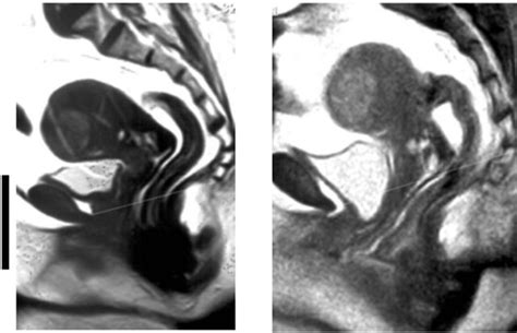 Popq System And Dynamic Mri In Assessment Of Female Genital Prolapse