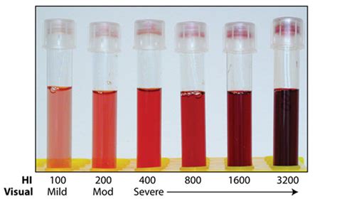 However, this is problematic when patients are in unfavorable conditions, and redrawing a blood sample is not feasible, or when hemolysis is an actual medical condition in some patients. Hemolysis index (HI) versus visual estimates of hemolysis ...