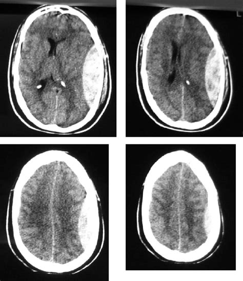 Emergency Department Skull Trephination For Epidural Hematoma In Patients Who Are Awake But