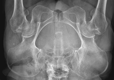 Anteroposterior Pelvic Radiograph Showing A Non Displaced Left Superior