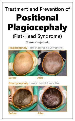 Positional Plagiocephaly Flat Head Syndrome Flat Head Syndrome Flat