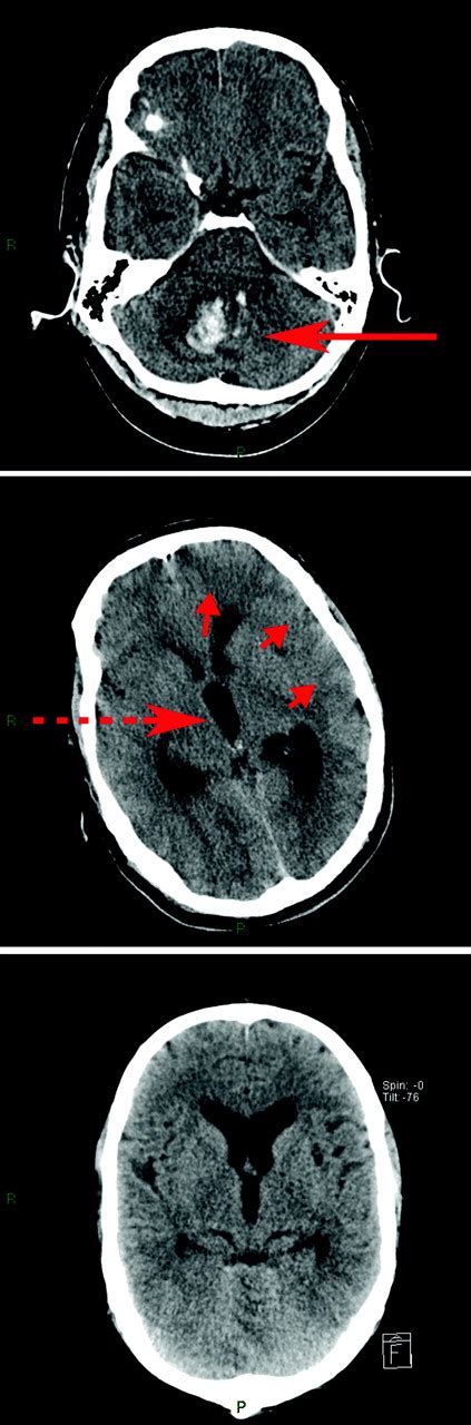 Spontaneous Intracerebral Haemorrhage The Bmj