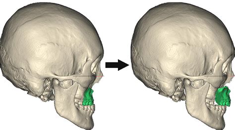 Accuracy Of Virtual Surgical Planning Assisted Management For Maxillary