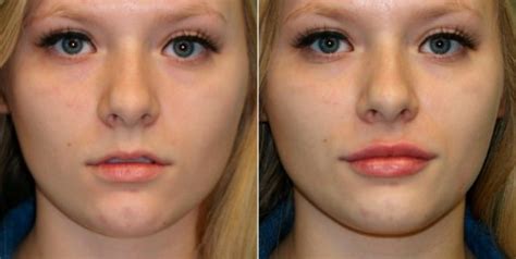 Lip Augmentation Before And After Photos Page 3 Of 6 The Naderi