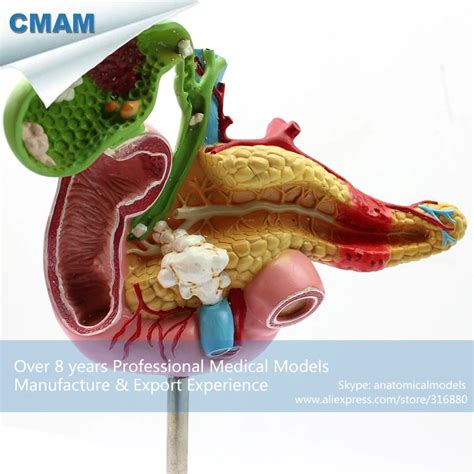 Buy 12541 Pathological Model Of Pancreas Duodenum