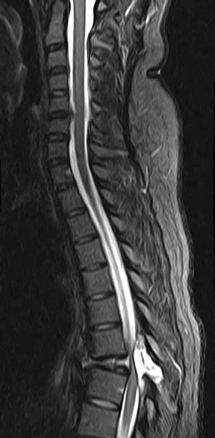 Aneurysmal Bone Cyst Spine Image