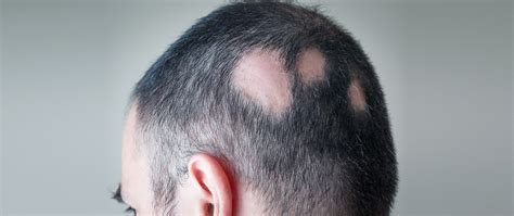 Alopecia areata is a form of alopecia (hair loss). Alopecia | MediCapilar