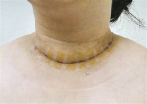 Thyroidectomy Robotic Surgery